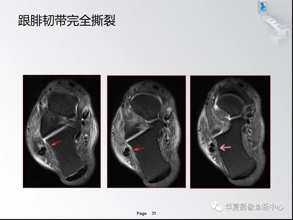 【PPT】踝关节韧带损伤MR表现与损伤机制分析-33 【PPT】踝关节韧带损伤MR表现与损伤机制分析-33