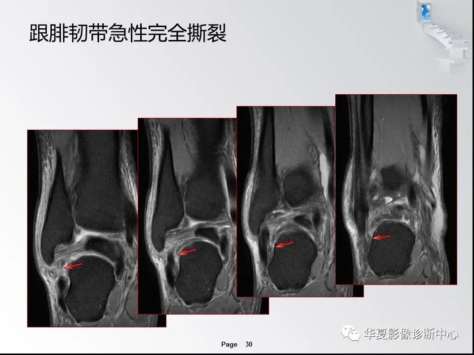 【PPT】踝关节韧带损伤MR表现与损伤机制分析-32 【PPT】踝关节韧带损伤MR表现与损伤机制分析-32