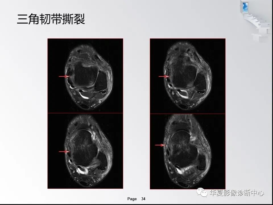 【PPT】踝关节韧带损伤MR表现与损伤机制分析-36 【PPT】踝关节韧带损伤MR表现与损伤机制分析-36