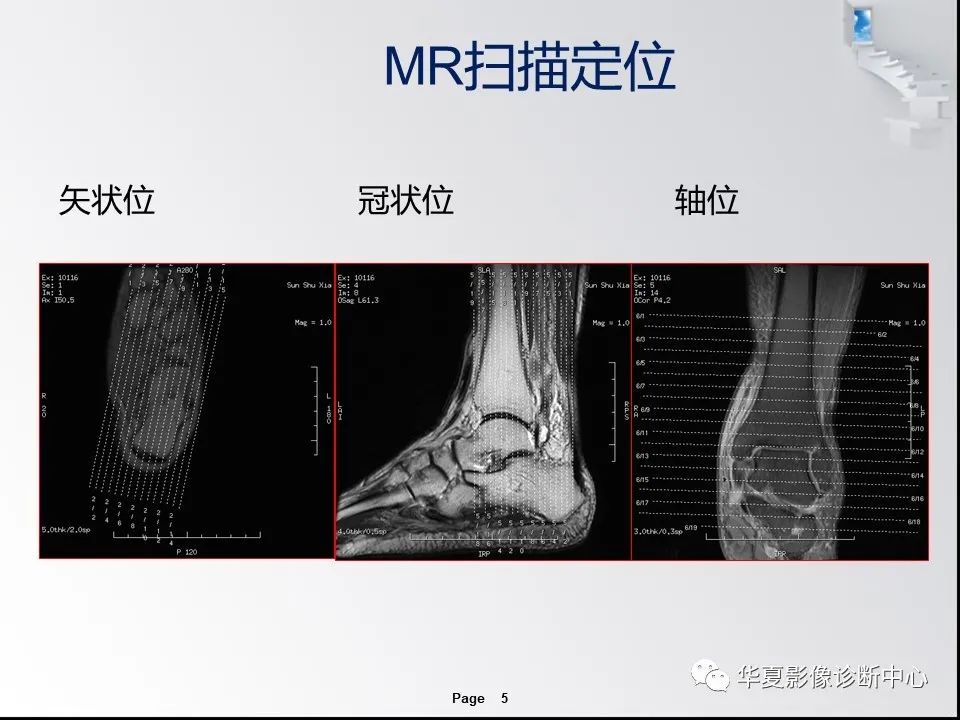 【PPT】踝关节韧带损伤MR表现与损伤机制分析-7 【PPT】踝关节韧带损伤MR表现与损伤机制分析-7