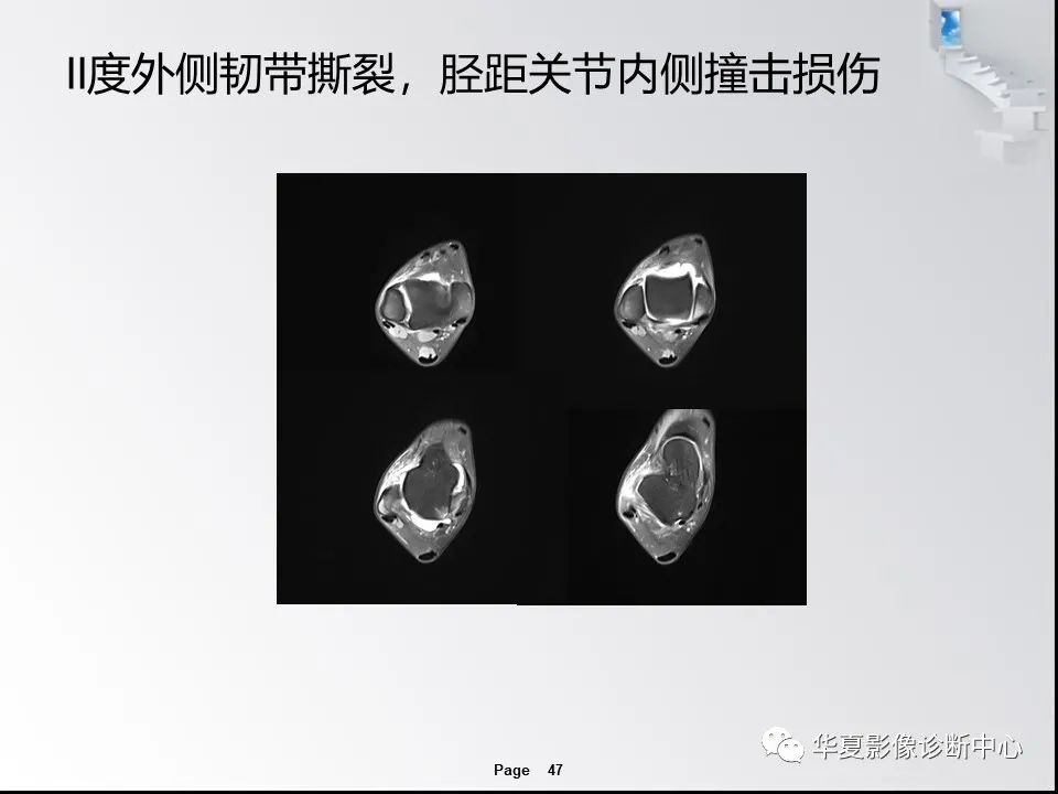 【PPT】踝关节韧带损伤MR表现与损伤机制分析-49 【PPT】踝关节韧带损伤MR表现与损伤机制分析-49