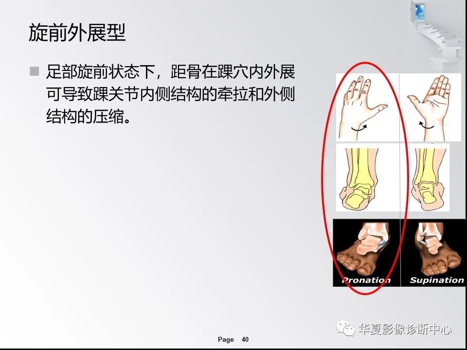 【PPT】踝关节韧带损伤MR表现与损伤机制分析-42 【PPT】踝关节韧带损伤MR表现与损伤机制分析-42