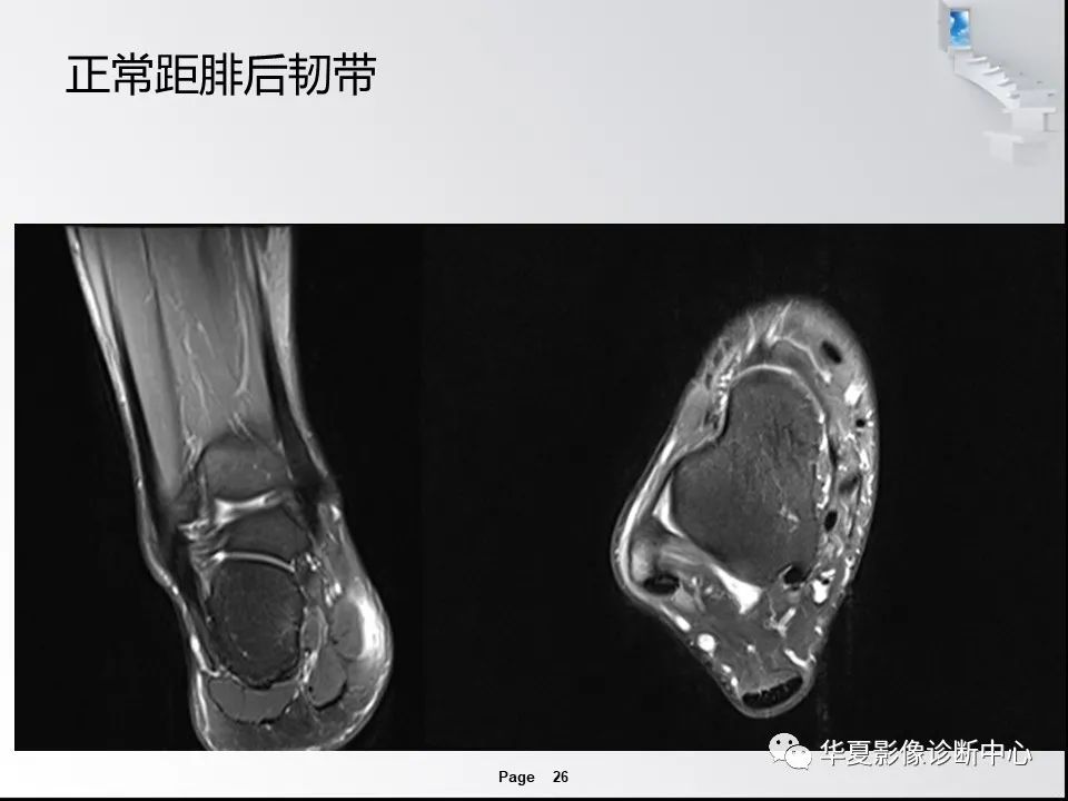 【PPT】踝关节韧带损伤MR表现与损伤机制分析-28 【PPT】踝关节韧带损伤MR表现与损伤机制分析-28