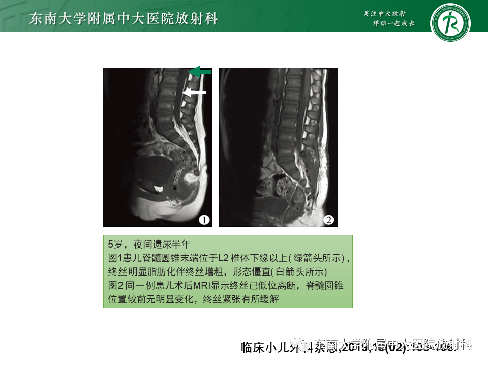 【PPT】脊髓拴系综合征-28