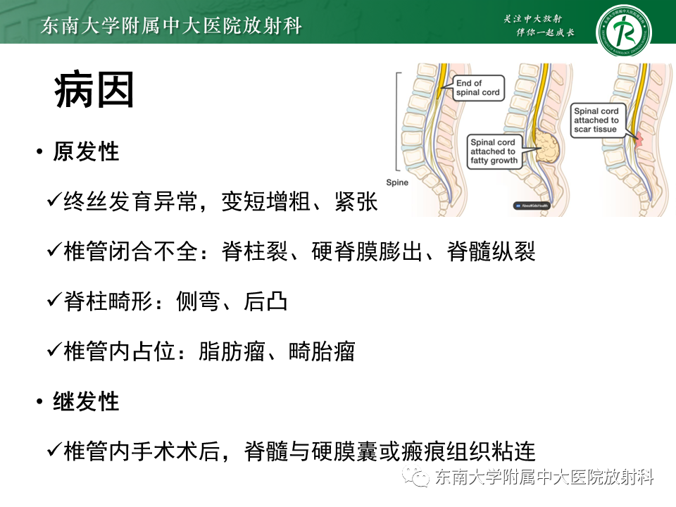 【PPT】脊髓拴系综合征-8