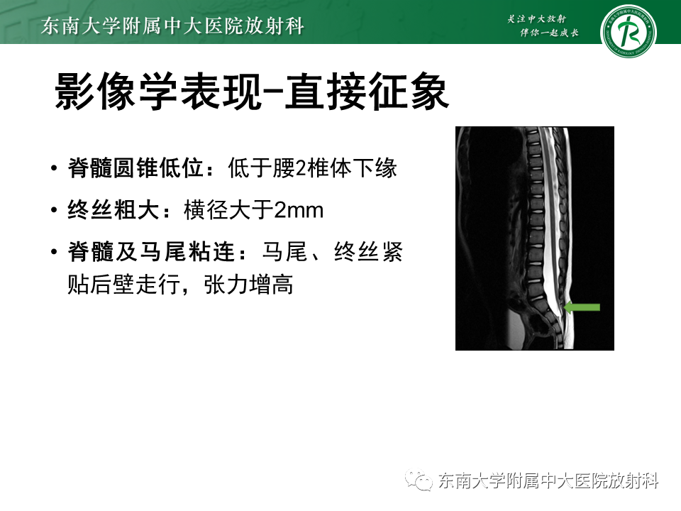 【PPT】脊髓拴系综合征-13
