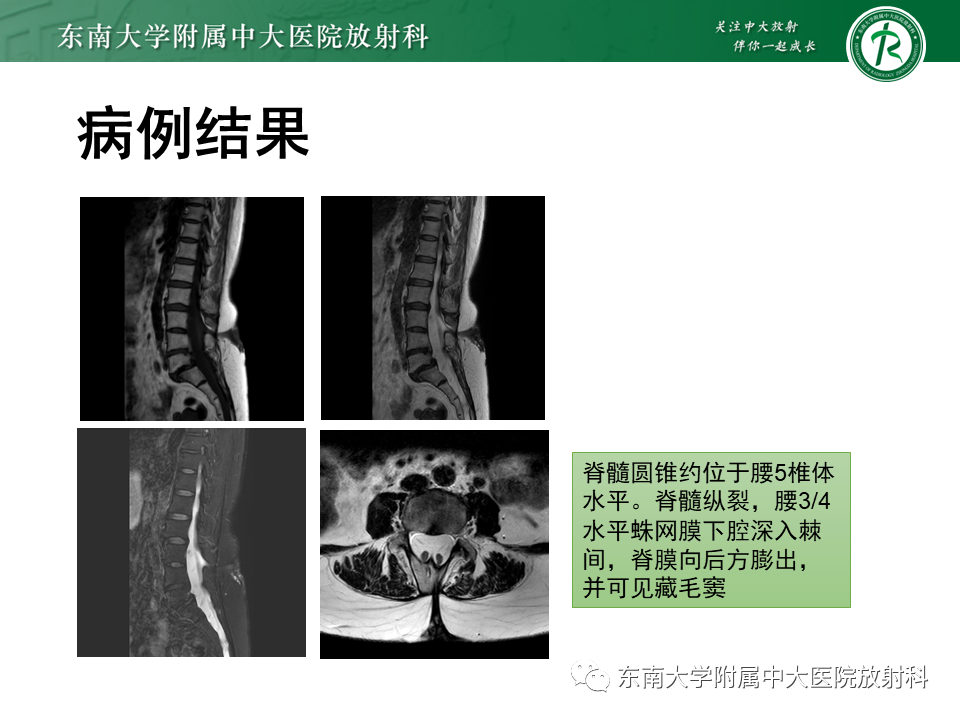 【PPT】脊髓拴系综合征-26