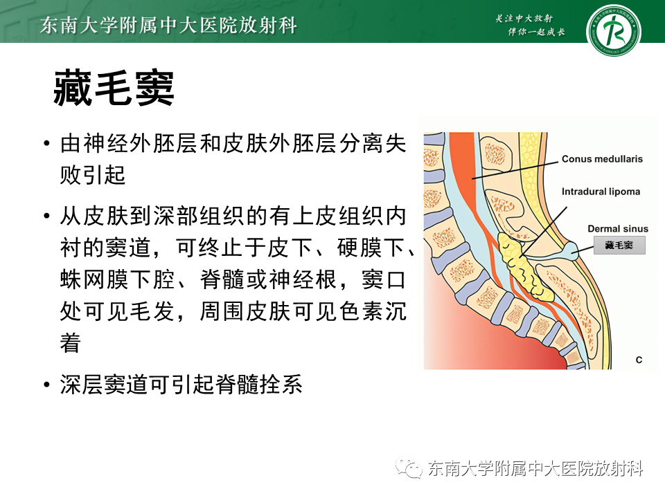 【PPT】脊髓拴系综合征-24