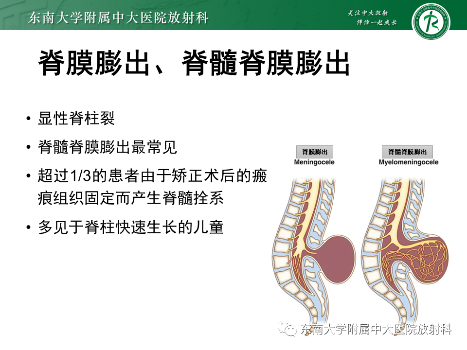 【PPT】脊髓拴系综合征-15