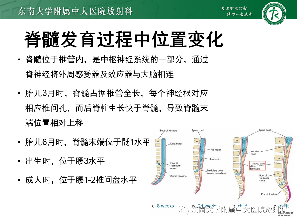 【PPT】脊髓拴系综合征-5
