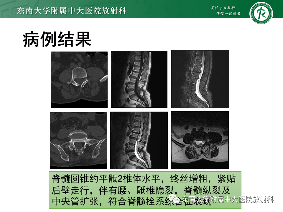 【PPT】脊髓拴系综合征-3
