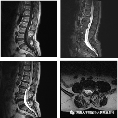 【PPT】脊髓拴系综合征-2