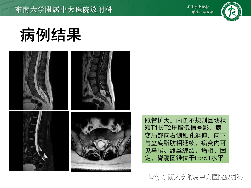 【PPT】脊髓拴系综合征-20