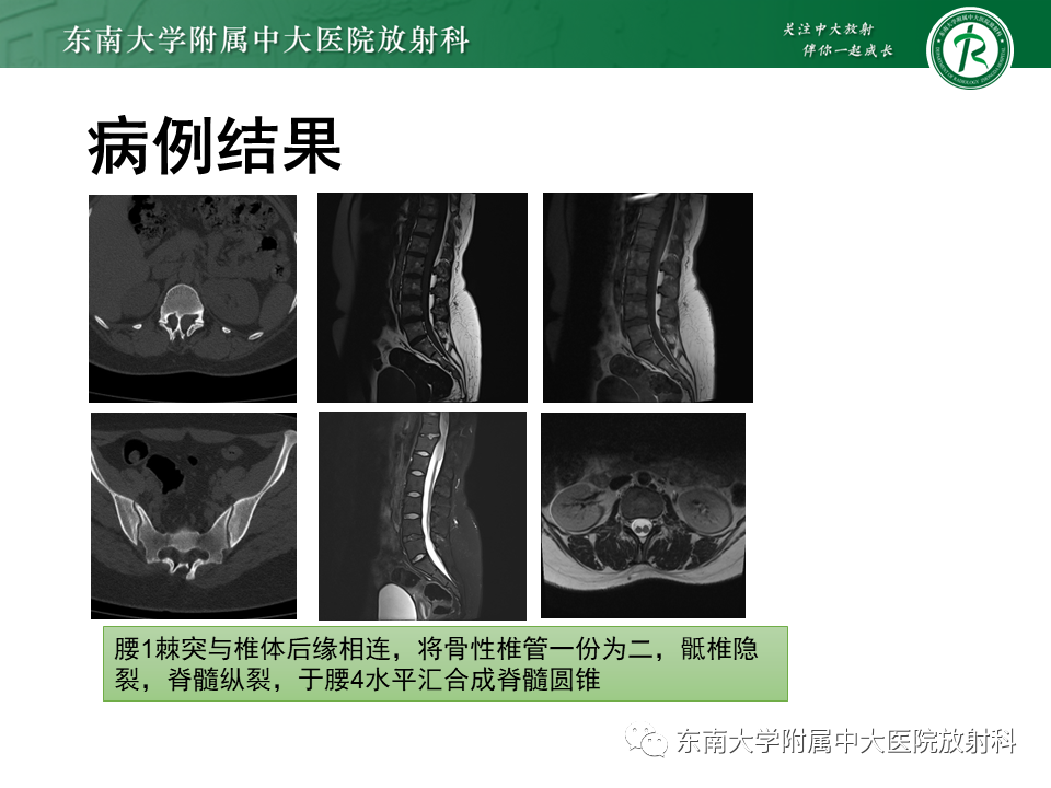 【PPT】脊髓拴系综合征-23