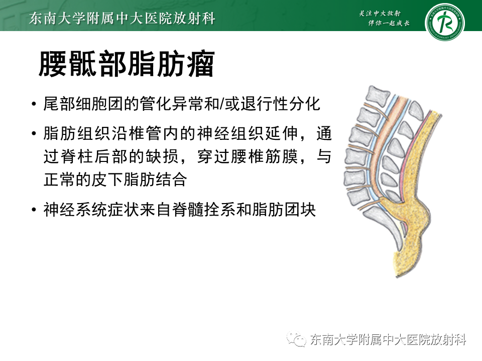 【PPT】脊髓拴系综合征-18