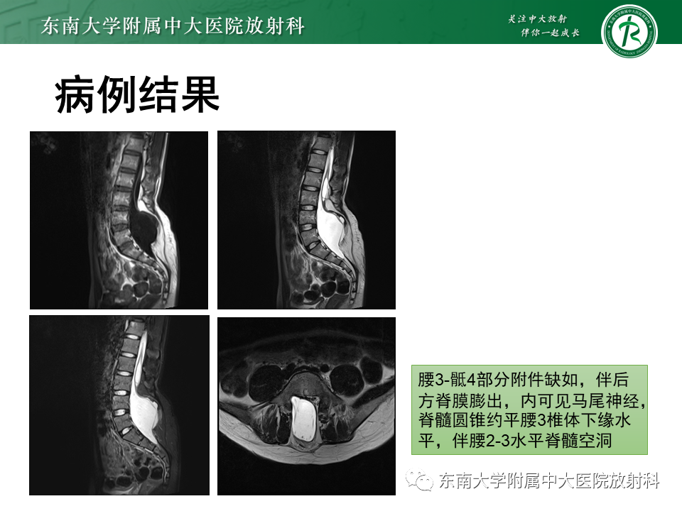 【PPT】脊髓拴系综合征-17