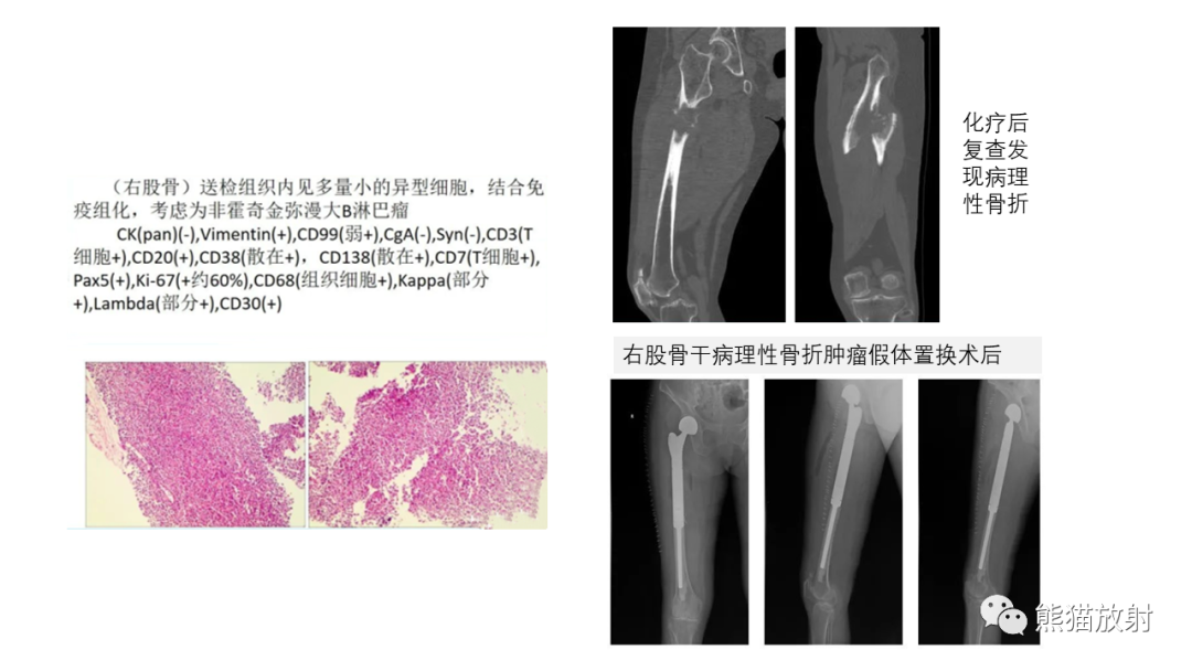 【病例】股骨淋巴瘤 VS 股骨转移瘤-24