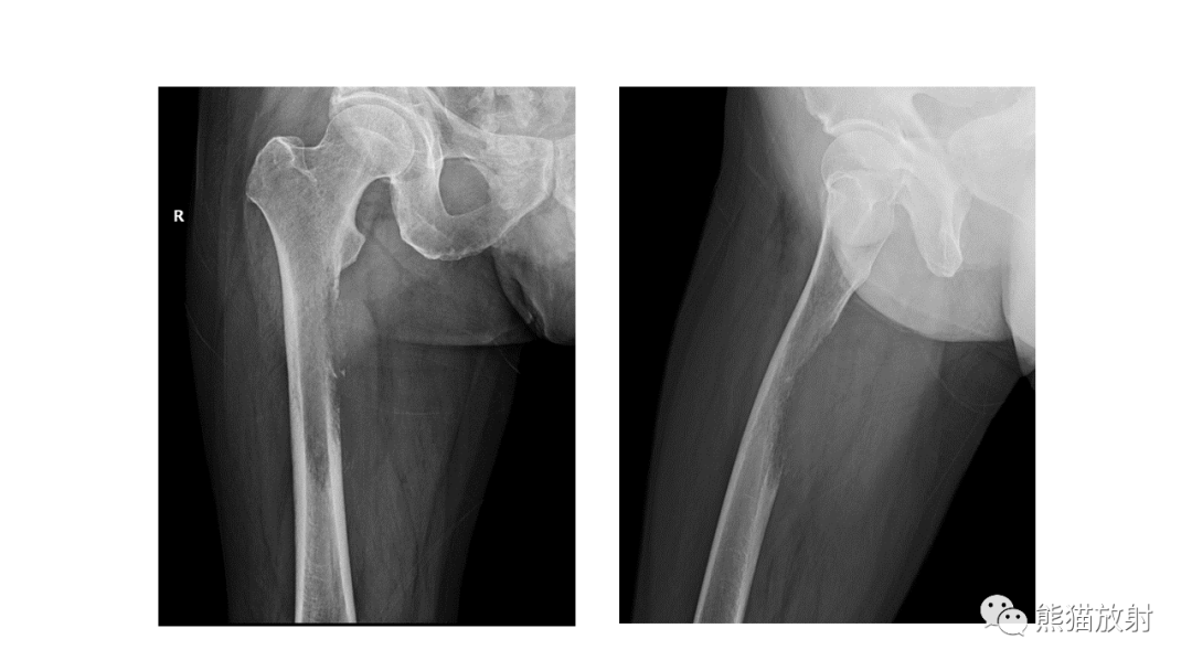 【病例】股骨淋巴瘤 VS 股骨转移瘤-9