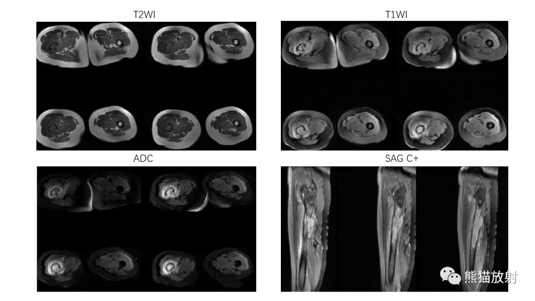 【病例】股骨淋巴瘤 VS 股骨转移瘤-22