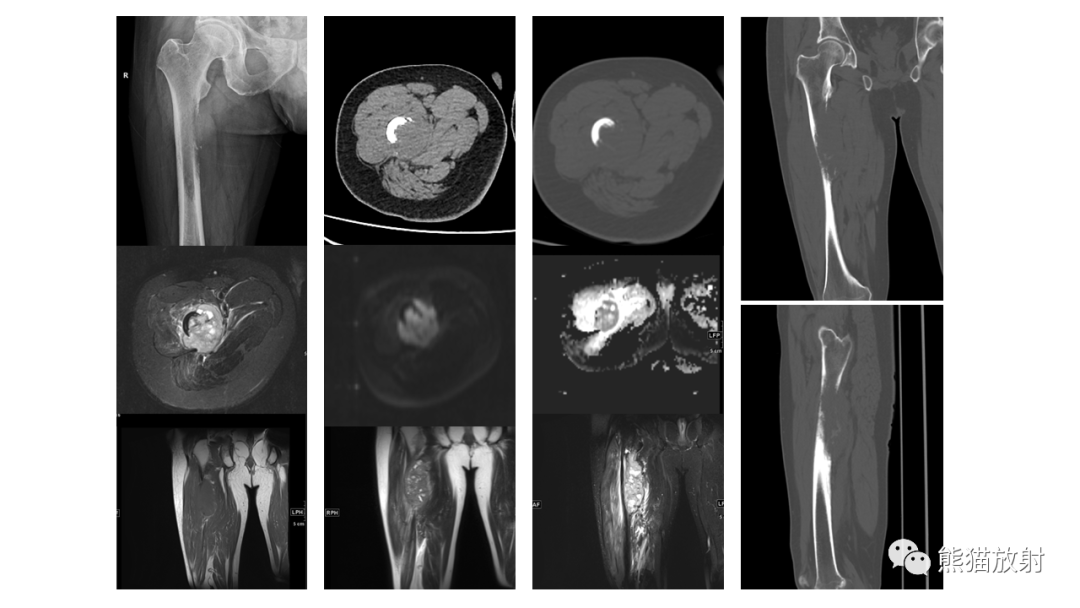 【病例】股骨淋巴瘤 VS 股骨转移瘤-10