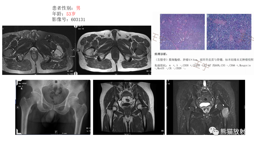 【病例】股骨淋巴瘤 VS 股骨转移瘤-40