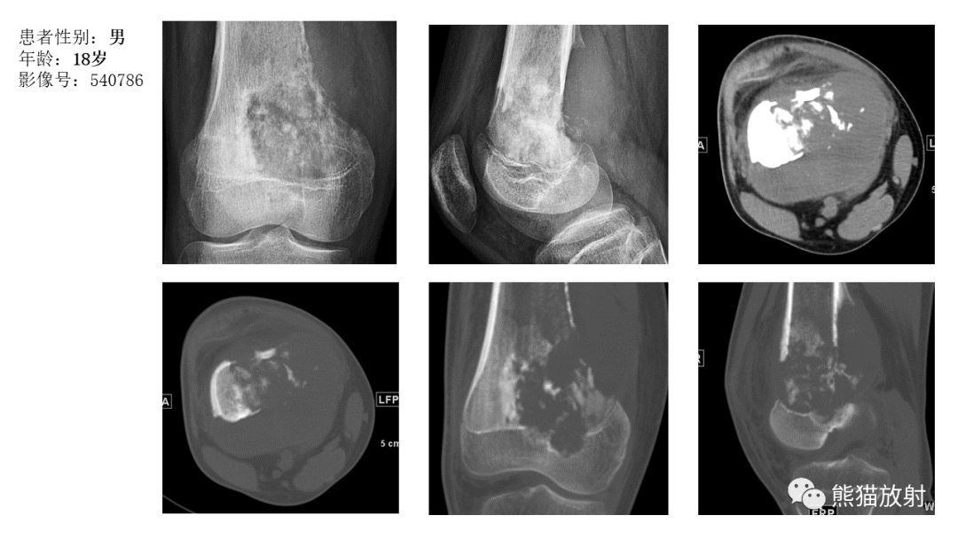 【病例】股骨淋巴瘤 VS 股骨转移瘤-33