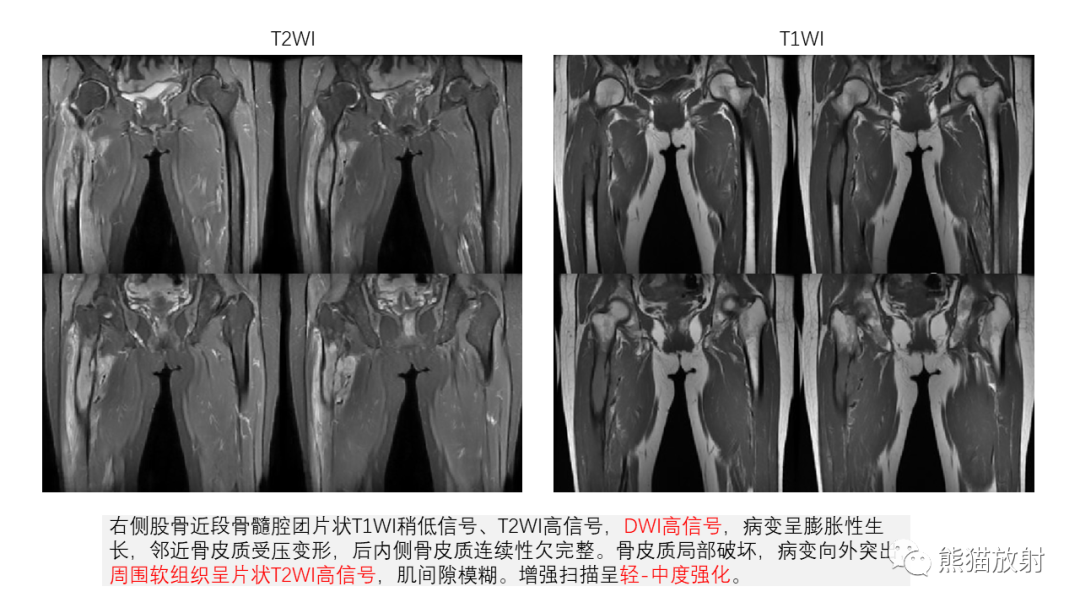 【病例】股骨淋巴瘤 VS 股骨转移瘤-23
