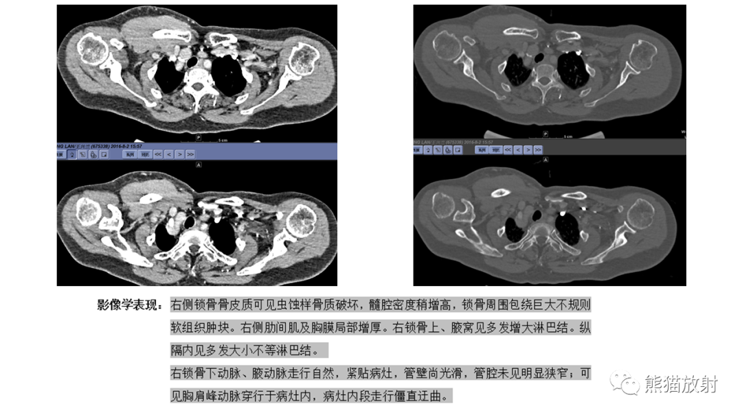 【病例】股骨淋巴瘤 VS 股骨转移瘤-26
