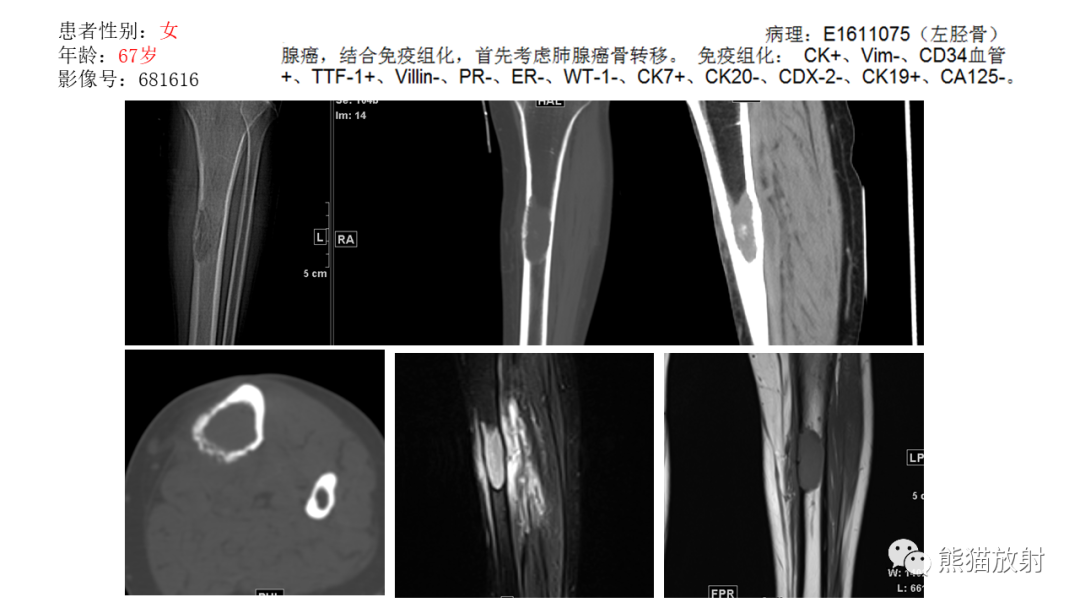【病例】股骨淋巴瘤 VS 股骨转移瘤-38