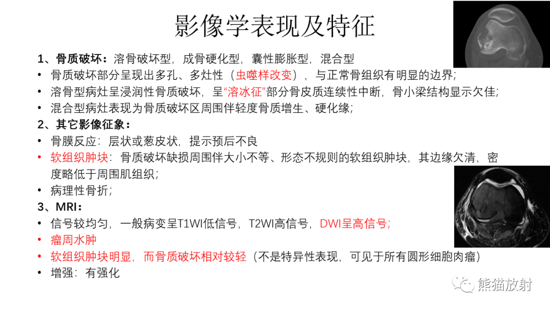 【病例】股骨淋巴瘤 VS 股骨转移瘤-18