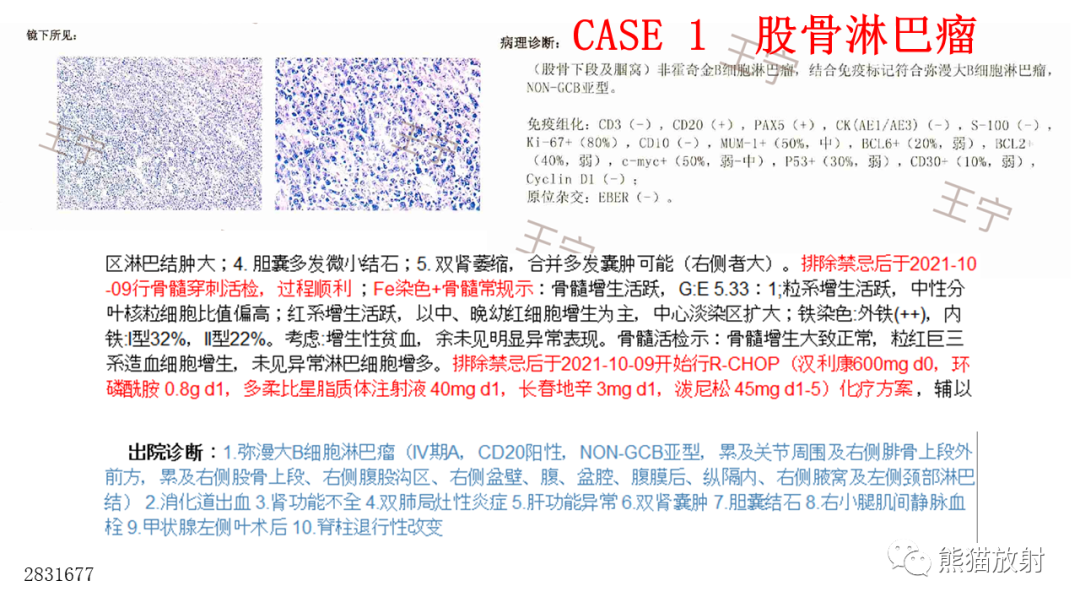 【病例】股骨淋巴瘤 VS 股骨转移瘤-12