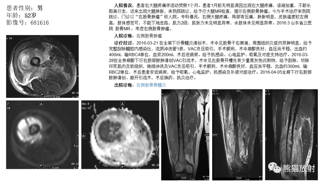 【病例】股骨淋巴瘤 VS 股骨转移瘤-42