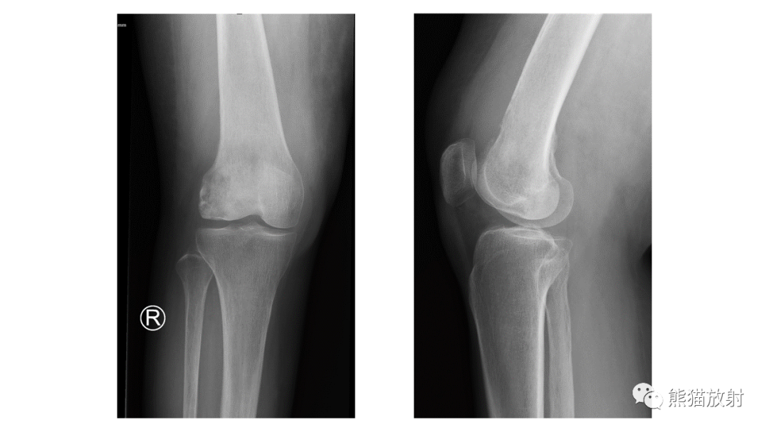 【病例】股骨淋巴瘤 VS 股骨转移瘤-4
