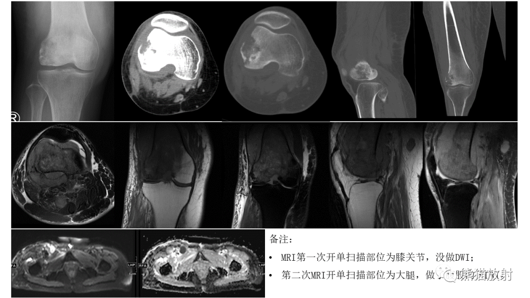 【病例】股骨淋巴瘤 VS 股骨转移瘤-5