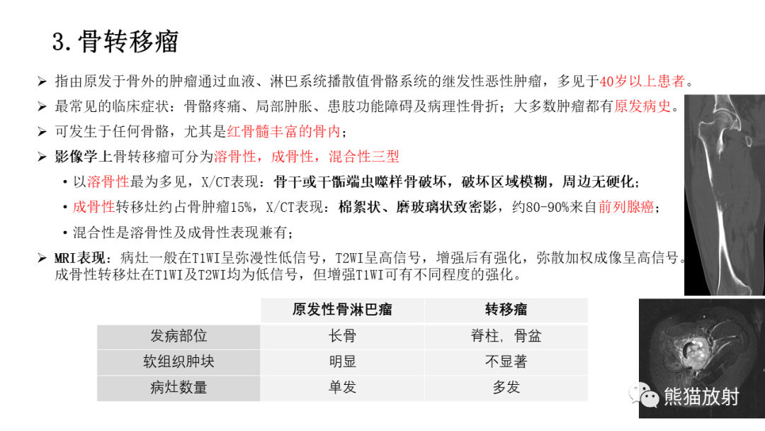 【病例】股骨淋巴瘤 VS 股骨转移瘤-37