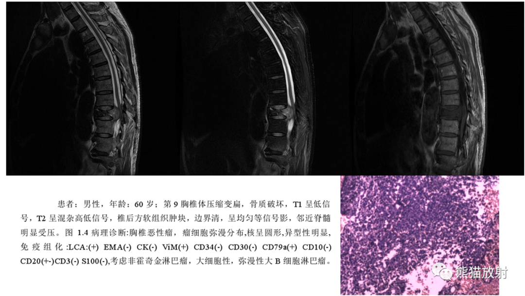 【病例】股骨淋巴瘤 VS 股骨转移瘤-28