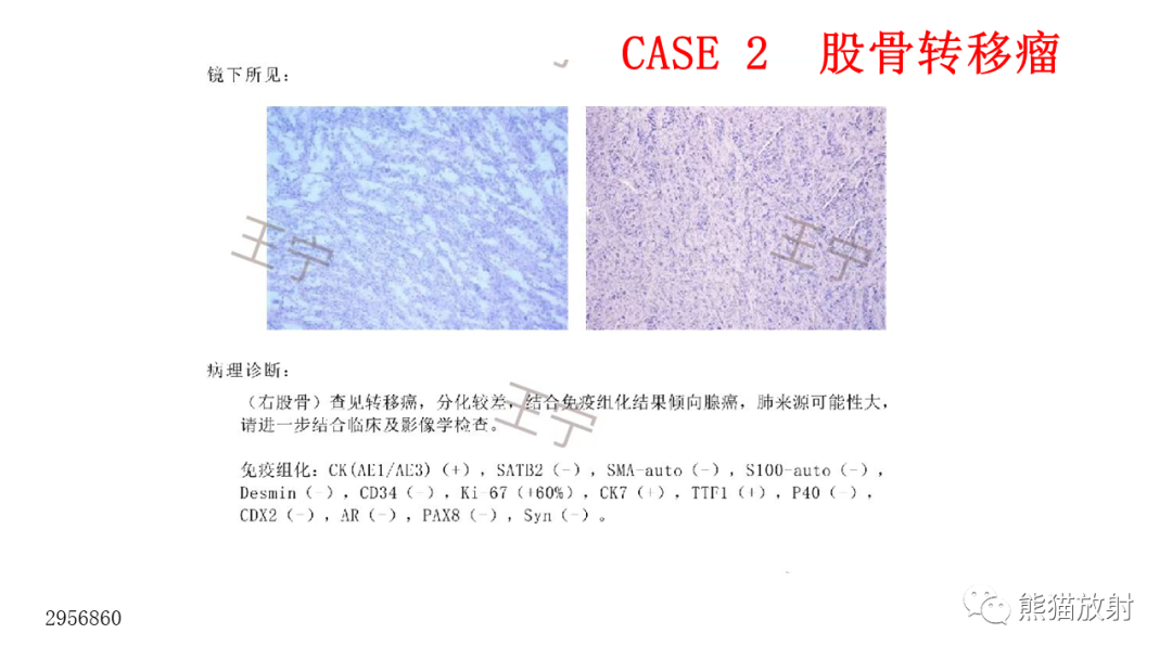 【病例】股骨淋巴瘤 VS 股骨转移瘤-13