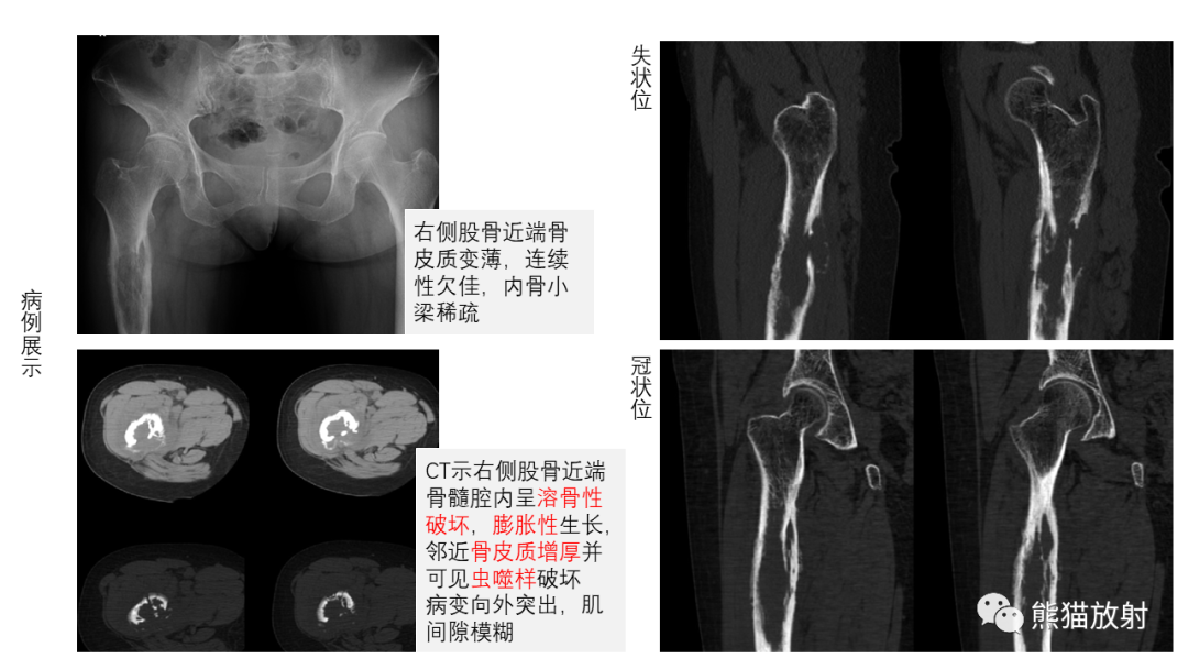 【病例】股骨淋巴瘤 VS 股骨转移瘤-21