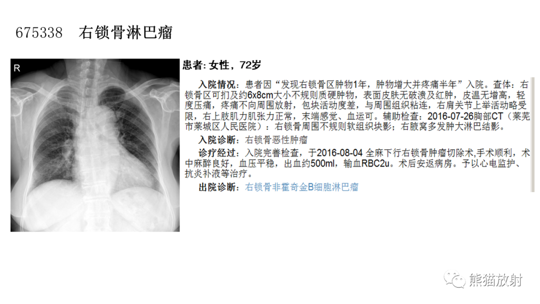 【病例】股骨淋巴瘤 VS 股骨转移瘤-25