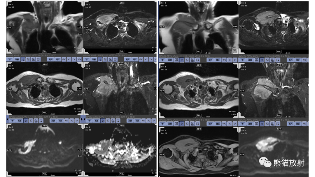 【病例】股骨淋巴瘤 VS 股骨转移瘤-27
