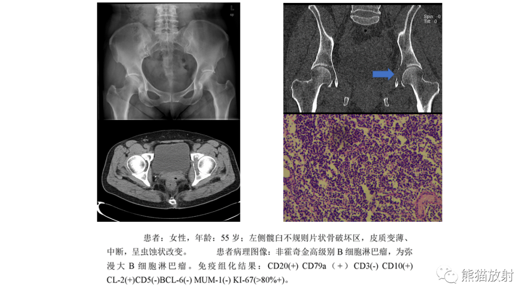 【病例】股骨淋巴瘤 VS 股骨转移瘤-29