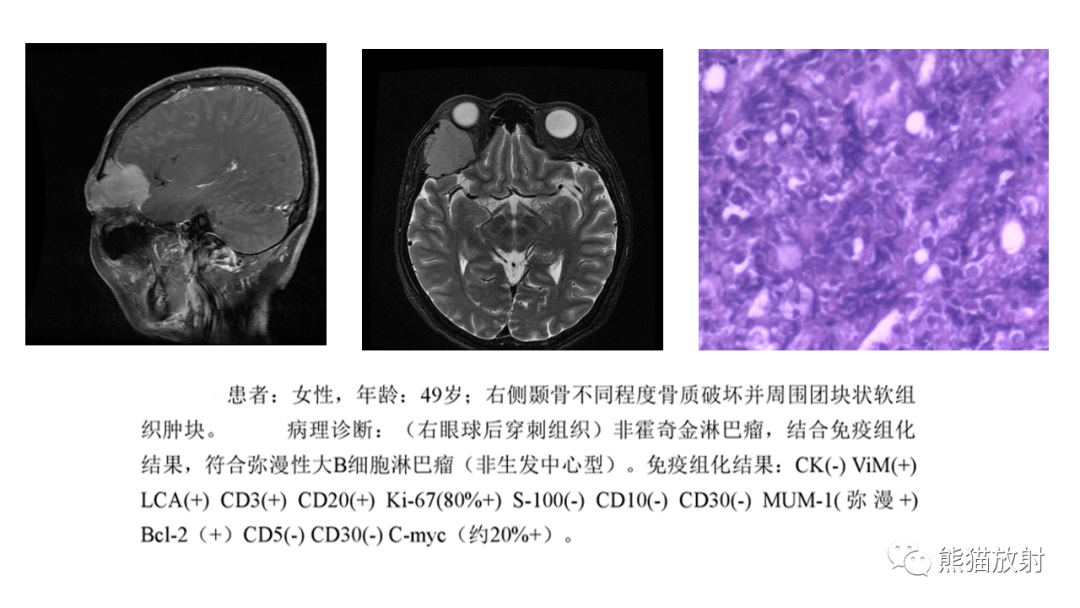 【病例】股骨淋巴瘤 VS 股骨转移瘤-30