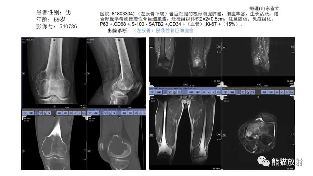 【病例】股骨淋巴瘤 VS 股骨转移瘤-36