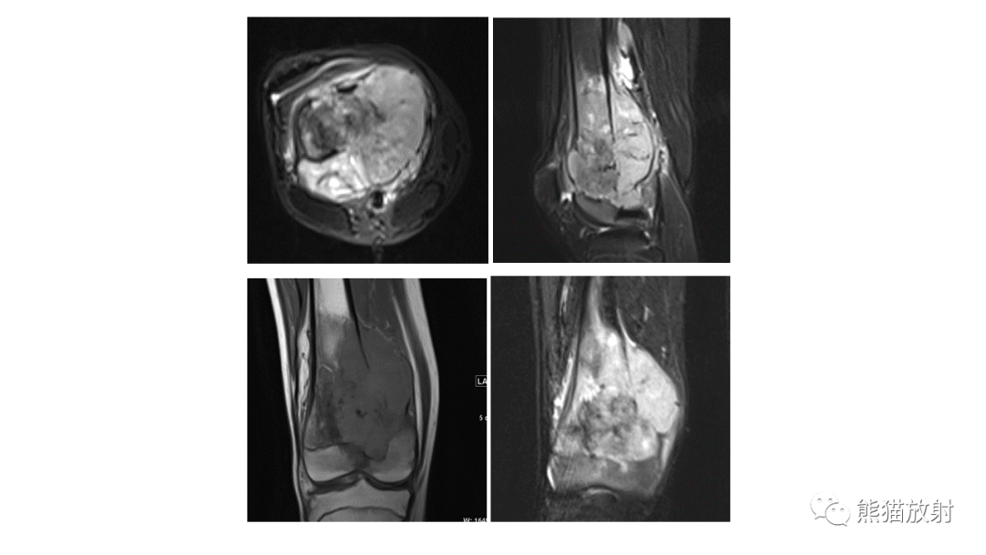 【病例】股骨淋巴瘤 VS 股骨转移瘤-34