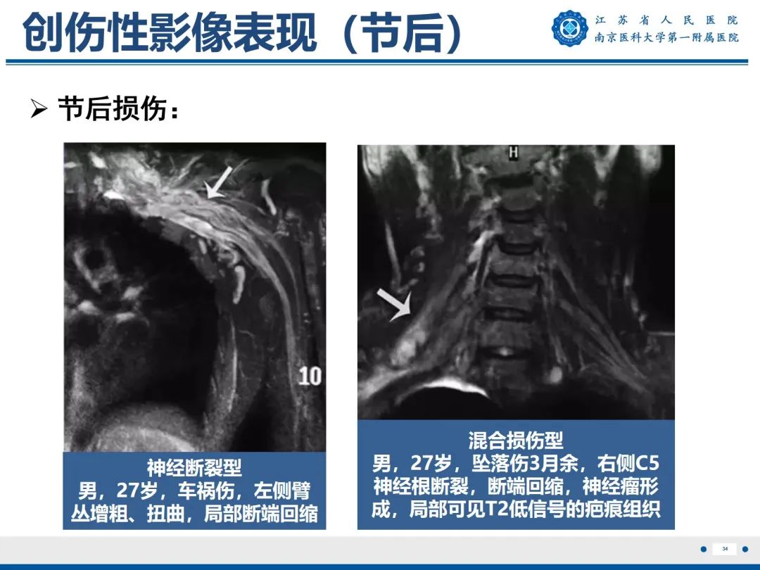【PPT】臂丛病变-35