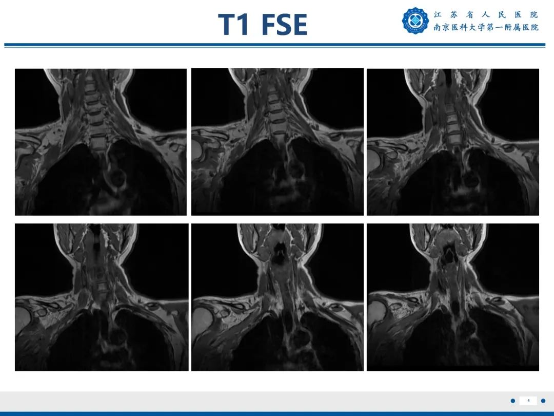 【PPT】臂丛病变-5