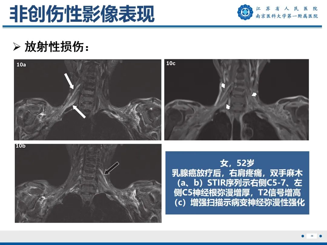 【PPT】臂丛病变-37