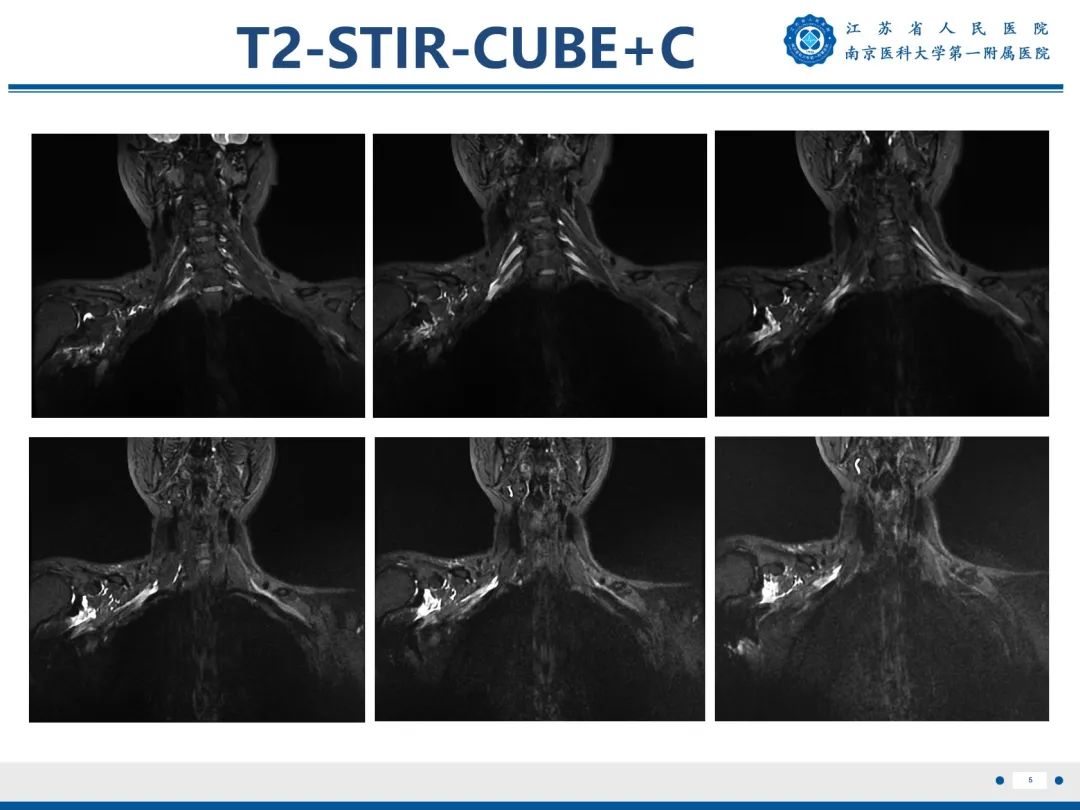 【PPT】臂丛病变-6
