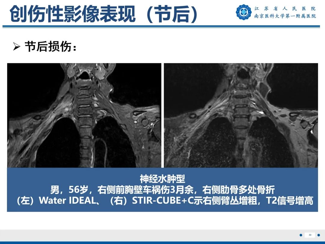 【PPT】臂丛病变-34