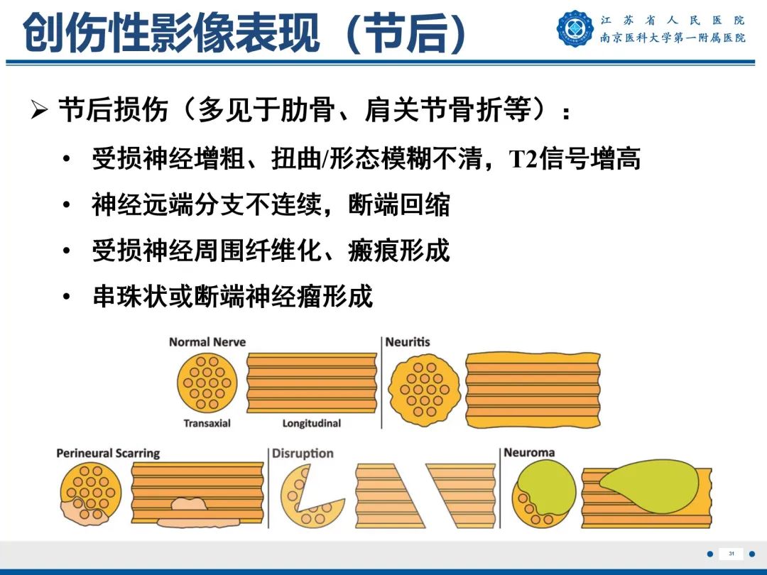 【PPT】臂丛病变-32